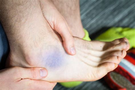 Bruise near ankle stock image. Image of runners, barefoot - 100850513