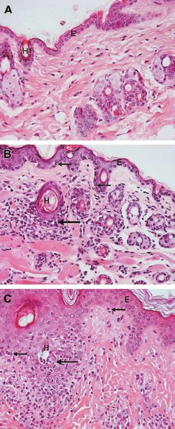 Skin histology of a mouse with X-GVHD compared with a control mouse and ...