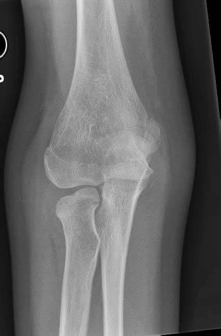 Congenital: Congenital Radial Head Dislocation