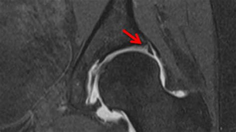 Hip Arthroscopy for Labral Tears - Keck Medicine of USC