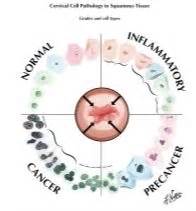 Abnormal Pap Smear: ASCUS or AGCUS Cervical Cell Pathology in Squamous ...