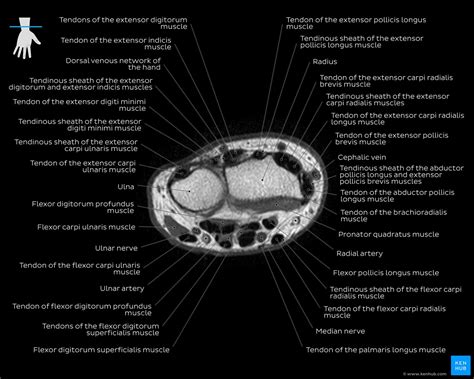 Extensor Pollicis Longus Mri