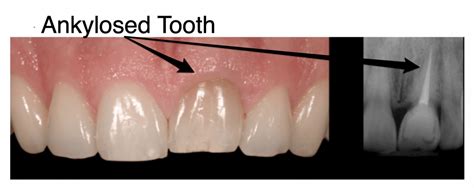 What Is an Ankylosed Tooth? - ArchWired