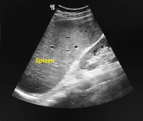 Jaundice echocardiography or ultrasound - wikidoc