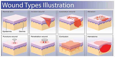 5.1 Lesson: Types of wounds | Siren Training