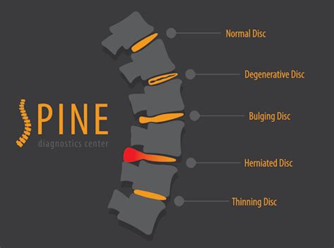 Degenerative Disc Disease: What is it and what are the common causes ...