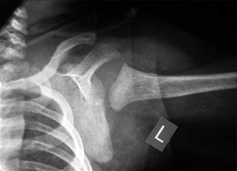 CONGENITAL RADIAL HEAD DISLOCATION | buyxraysonline