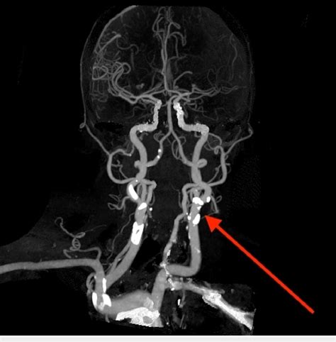 CT angiogram of the head and neck shows showing irregular calcified ...