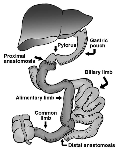 agitação doméstico só duodenal switch complications Jaqueta Classificar ...