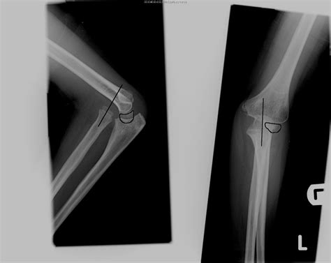 Congenital: Congenital Radial Head Dislocation