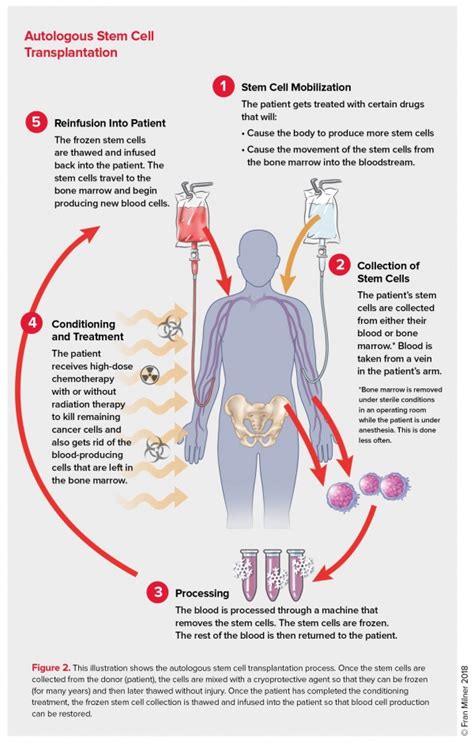 Bone Marrow Transplant Stem Cell