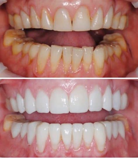 Veneers Before and After Results