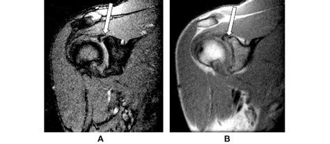 SLAP Lesion Type II. MRI oblique coronal view: (A) T2 ⁄ weighted ...