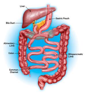 Duodenal Switch Bariatric Surgery Procedure