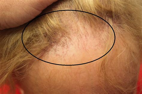 Frontal fibrosing alopecia causes, symptoms, diagnosis, treatment ...