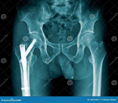 X-ray Image Hip Fracture or Intertrochanteric Fracture and Post ...