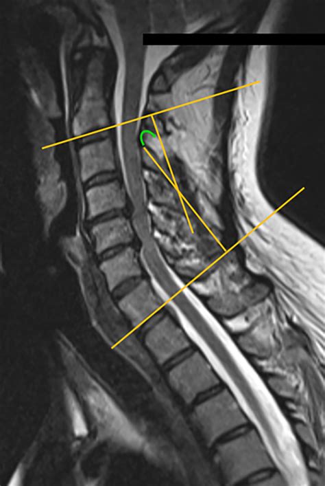 Abnormal Cervical Spine Mri