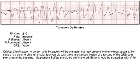 Ventricular Tachycardia Ekg Explained Images And Photos Finder