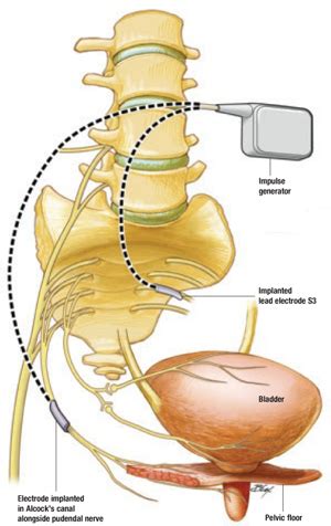 Interstim: An implantable device for implacable urinary symptoms ...