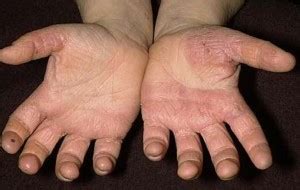 👉 Hand Fungus - Pictures, Symptoms, Treatment and Causes (February 2022)