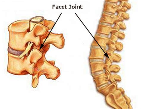 Facet Arthropathy | Current Health Advice, Health Blog Articles and Tips