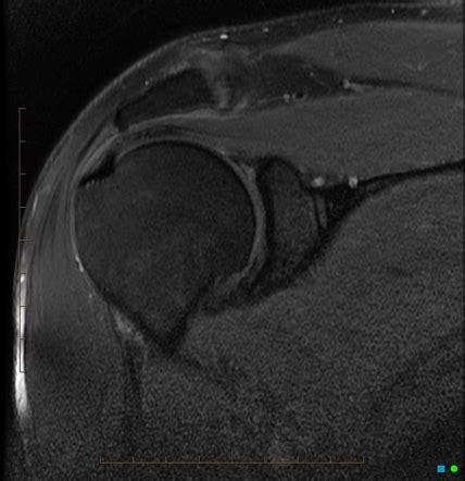 Superior labral anterior posterior tear | Radiology Reference Article ...