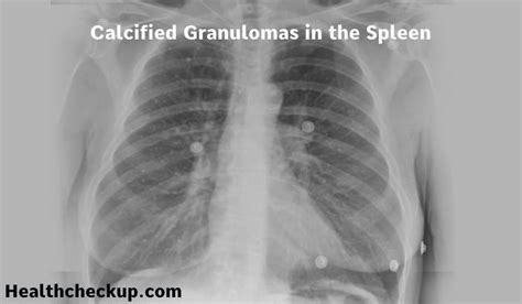 Calcified Granulomas in the Spleen: A Comprehensive Overview