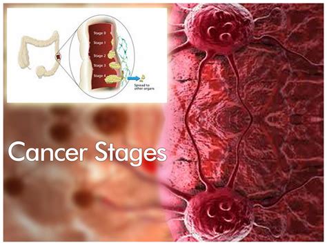 Cancer PPT, Cancer Slides, Cancer symptoms, Breast cancer, Lung cancer ...