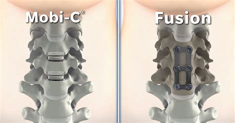 New procedure improves cervical spine surgery outcomes