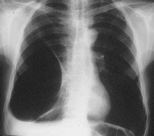 Emphysema-Chest Xray | Current Health Advice, Health Blog Articles and Tips