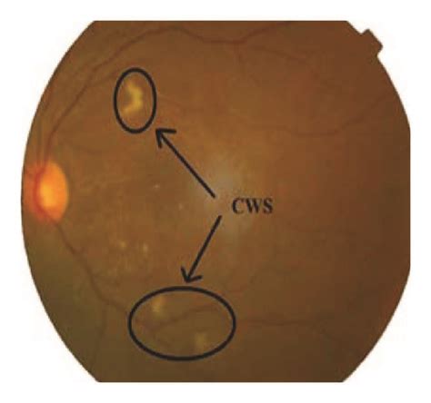 Cotton wool spot in retinal fundus image (in black circle) [32 ...