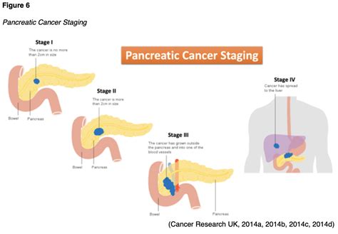 Stages Of Pancreatic Cancer