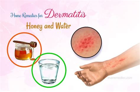 23 Natural Home Remedies For Dermatitis Symptom Relief