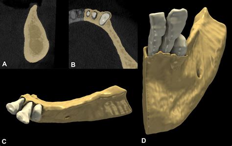 Baseline alveolar ridge morphology. A: Sagittal alveolar ridge outline ...