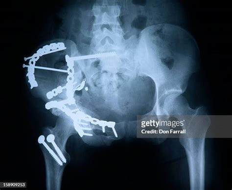 96 Hip Fracture X Ray Stock Photos, High-Res Pictures, and Images ...