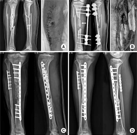 Tibia Fibula