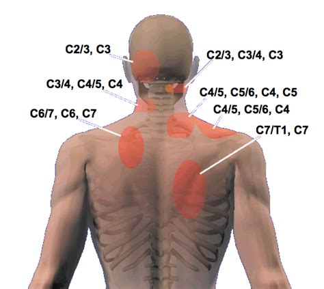 Cloward sign & Cervical Referral Patterns | Modern Manual Therapy Blog