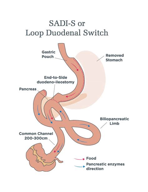 Duodenal Switch Procedures - SADI-S and Classic DS | UT Health Tyler ...