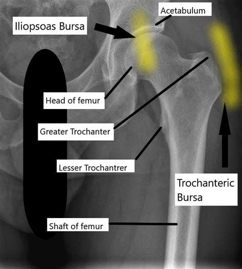 Hip Bursitis - Complete Orthopedics | Multiple NY Locations