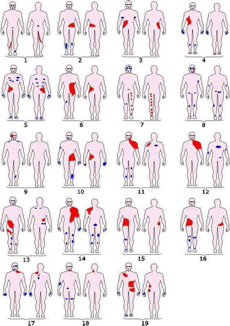 Different Types of Vitiligo • Vitiligo Cover