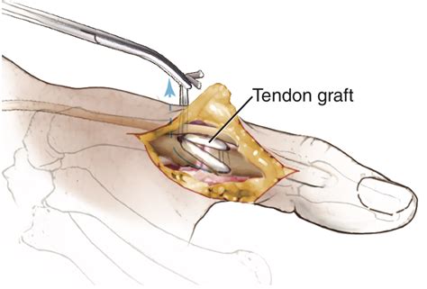 Ulnar Collateral Ligament Reconstruction