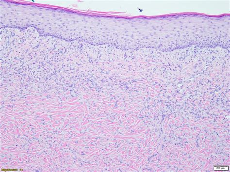 Dermatofibroma Histology