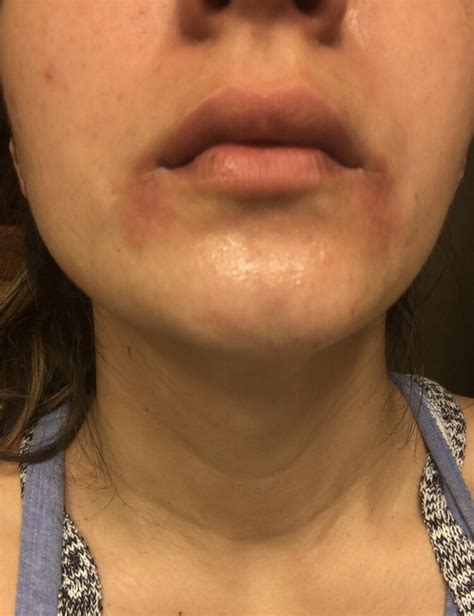 Skin Concerns Red Dry Patches On Sides Of Mouth Rskincareaddiction