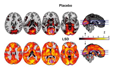 LSD and it effects on the brain