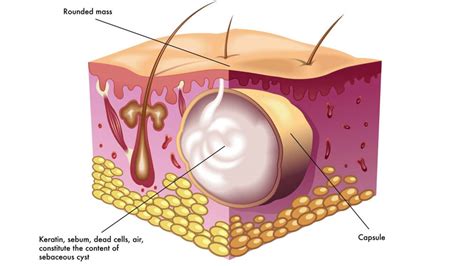 Sebaceous Cyst Removal - Excision Gold Coast | Skin Clinic Robina