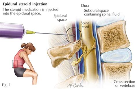 Epidural Steroid Injection - Pomona Pain Management Doctor | epidural ...