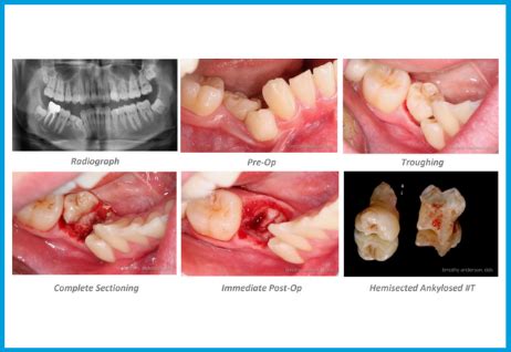 Ankylosed Tooth Extraction