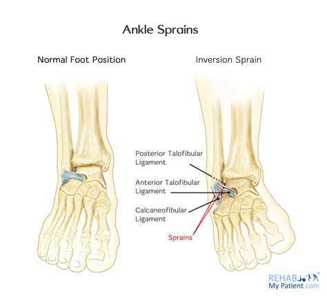 Ankle articles | Rehab My Patient