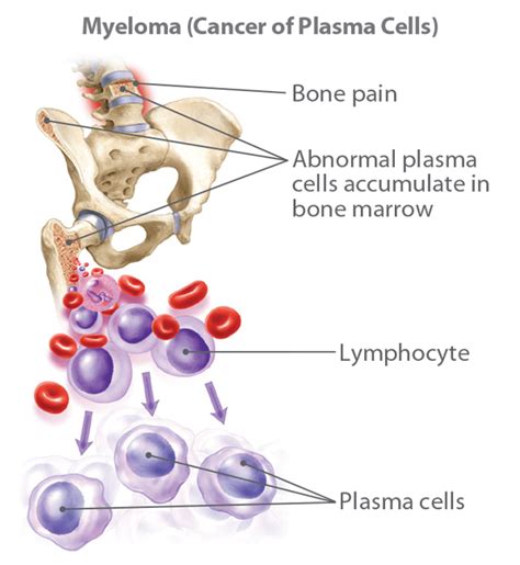 Multiple Myeloma: Causes, Symptoms & Treatments