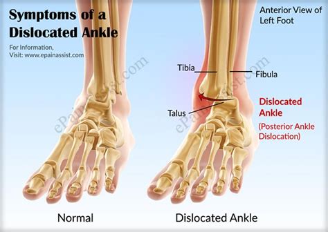 Dislocated Ankle|Treatment|Recovery|Prognosis|Causes|Symptoms